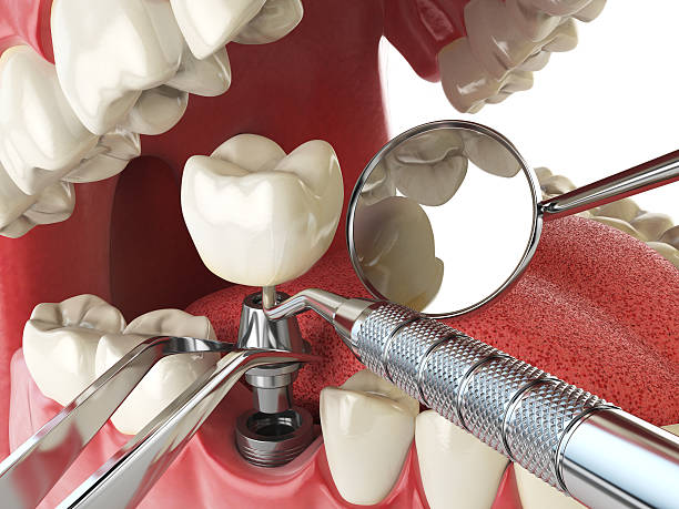 Best Emergency Wisdom Teeth Removal in Thomas, OK